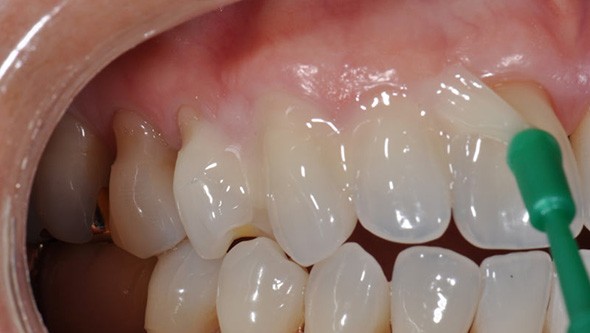 fluorizare davinci dental clinic
